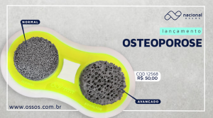 Read more about the article Osteoporose: O que é, tratamento e fatores de risco.