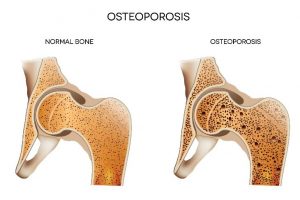 Imagem demonstrando um osso normal e um osso com osteoporose - Osteoporosis Nacional Ossos 