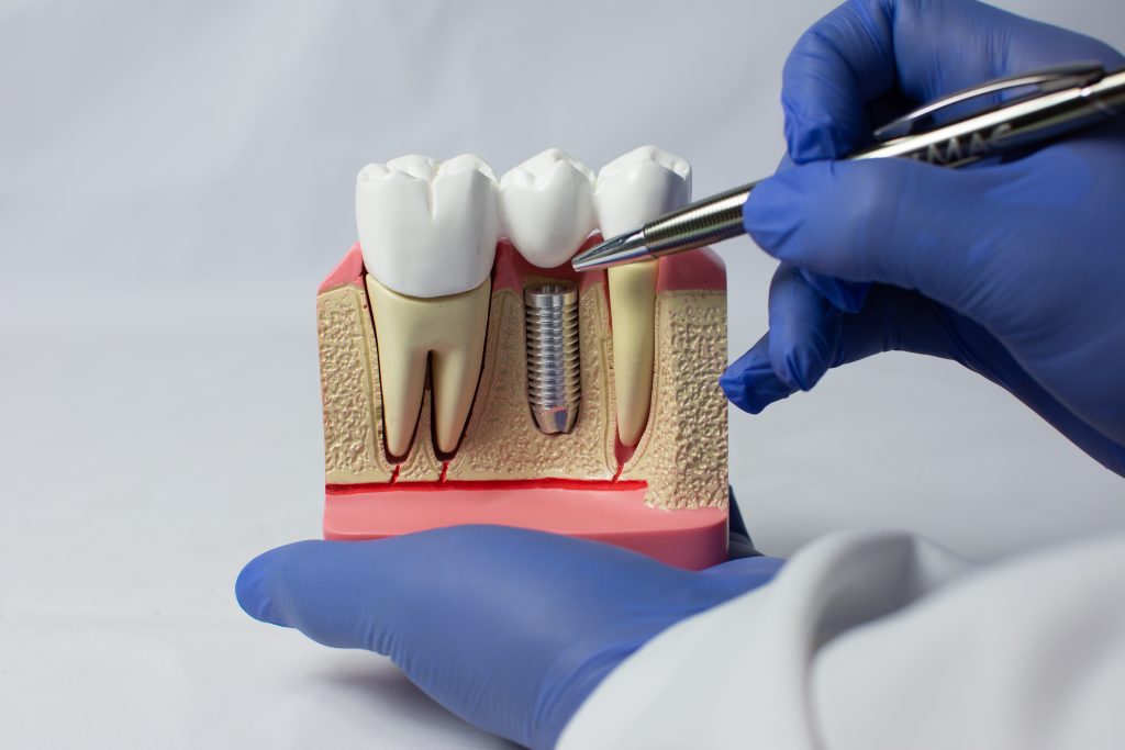 Implantodontia: Transformação através do Implante Dentário