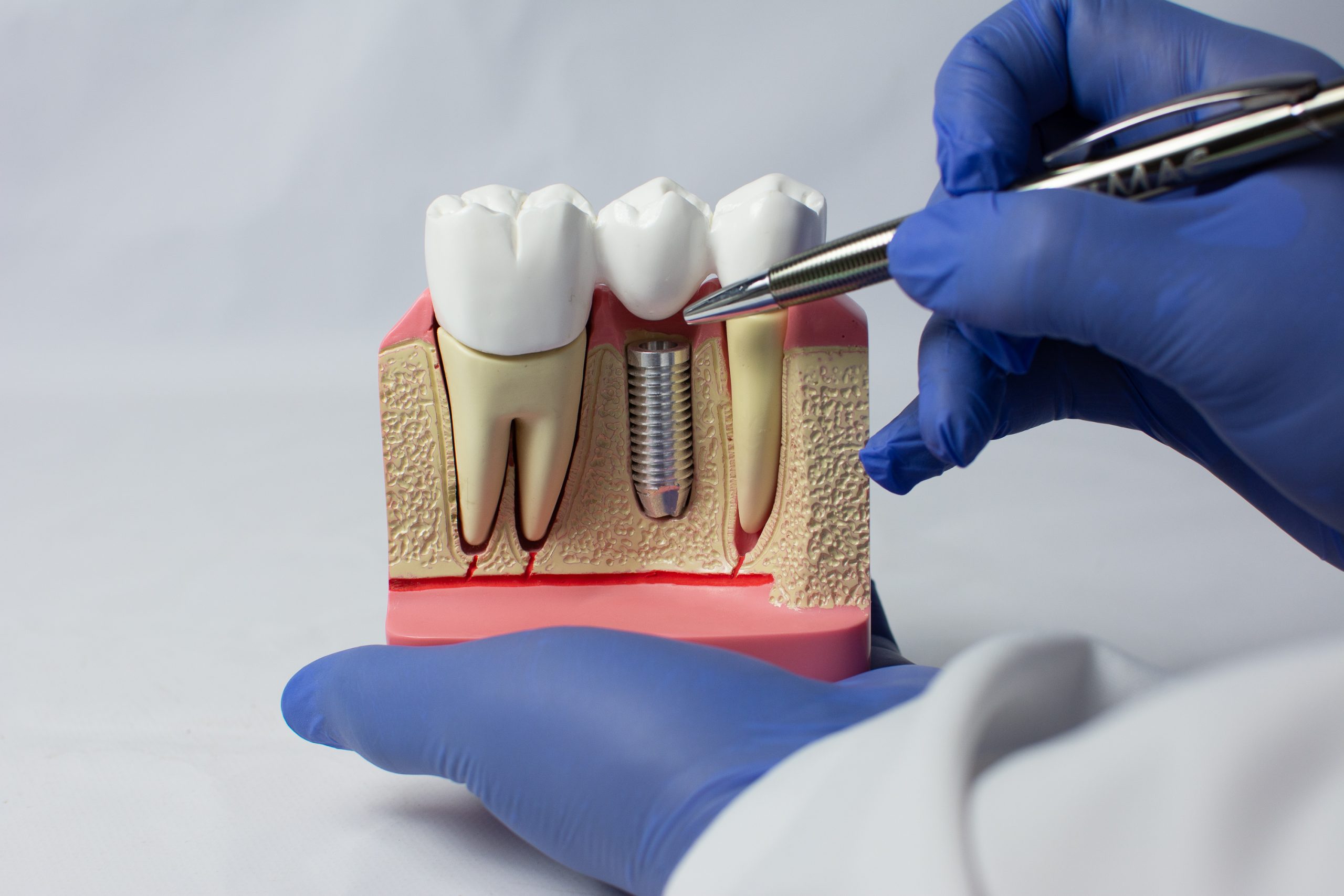 Leia mais sobre o artigo Implantodontia: Transformação através do Implante Dentário
